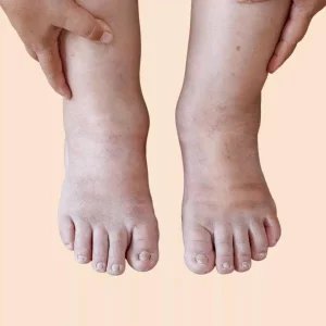 Lipedema Self-test feet