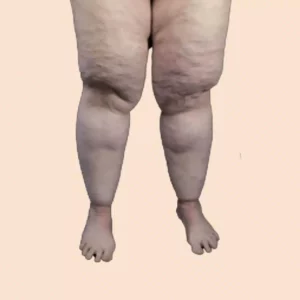 Lipedema Self-test thick legs