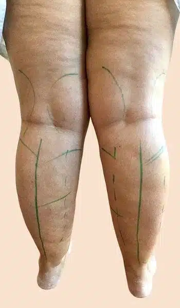 Lipedema before & after